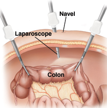 possible benefits of a laparoscopic approach