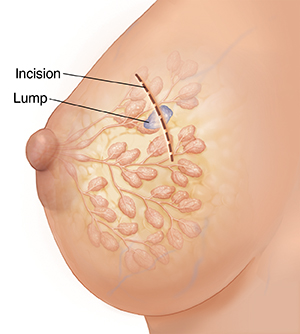 opensurgicalbiopsy