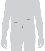 possible incision sites