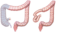 right hemicolectomy