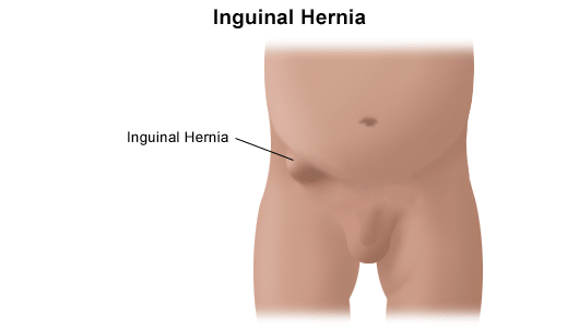 Inguinal Hernia