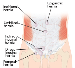 hernia